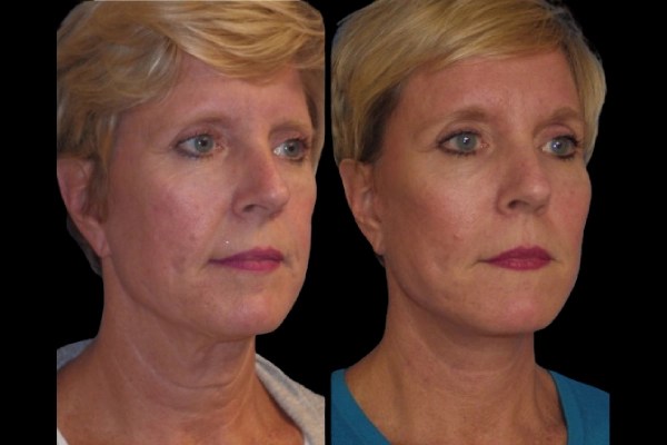 Face fat transfer pictures in dubai