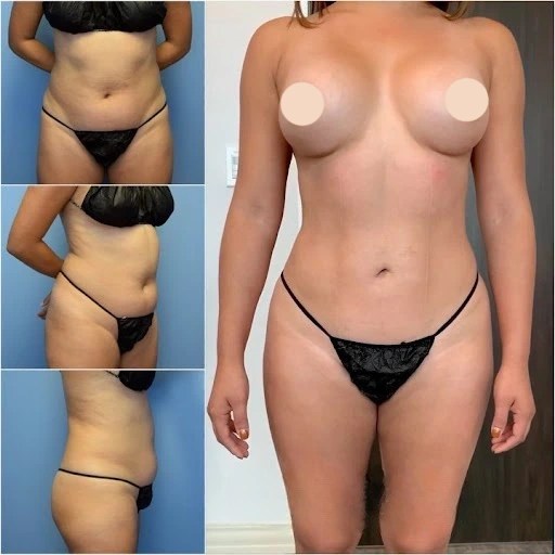 Body liposuction before and after