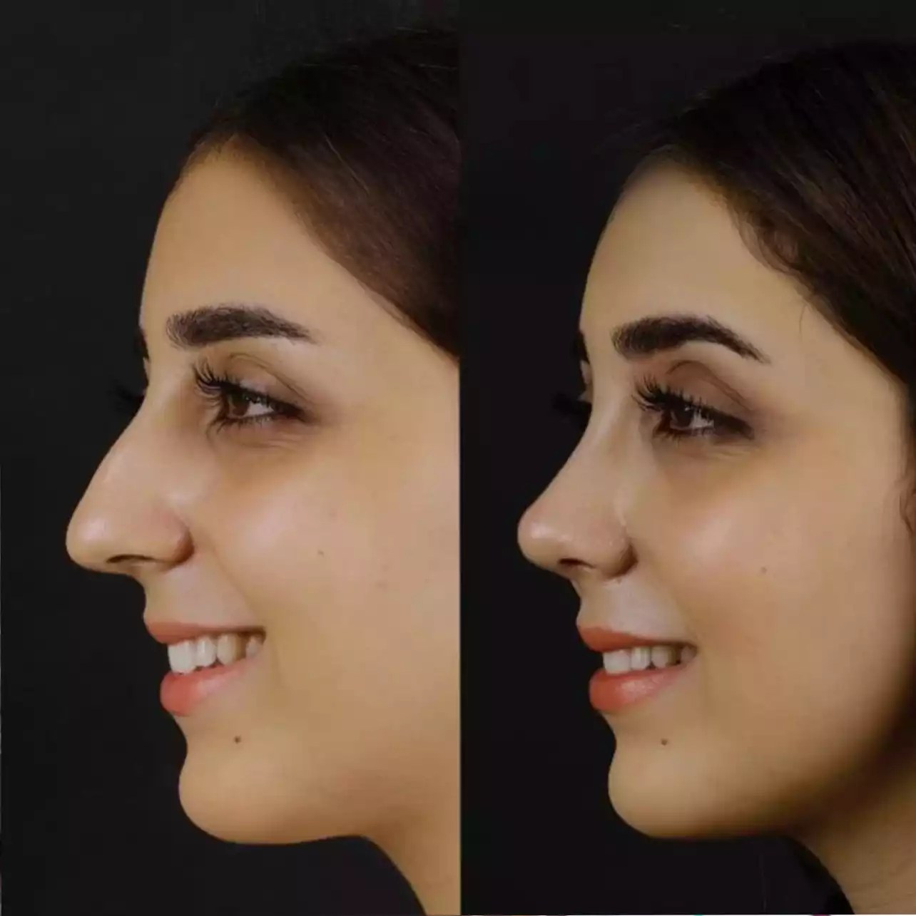 Nose tip plasty