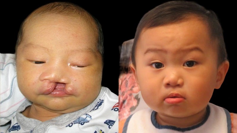 Cleft lip and palate in uae