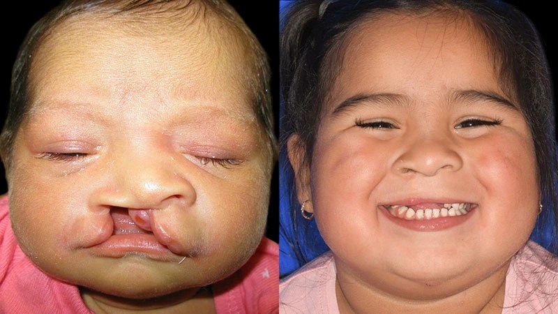 Cleft lip and palate before and after images in dubai