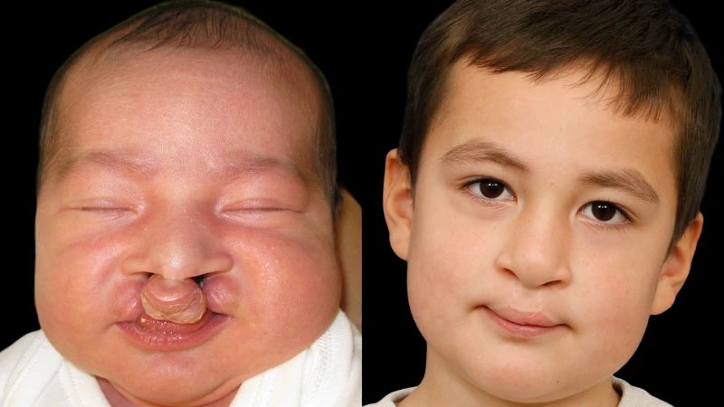 Cleft lip and palate before and after results in dubai