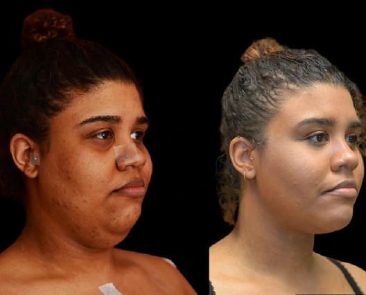 Face fat removal