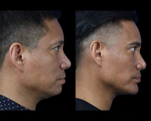 Face fat removal