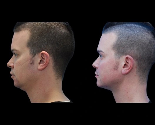 Face fat removal