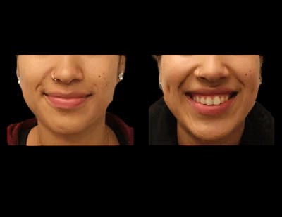 Facial reconstruction before after