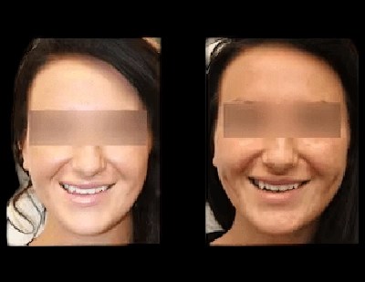 Dimple creation before and after results in dubai