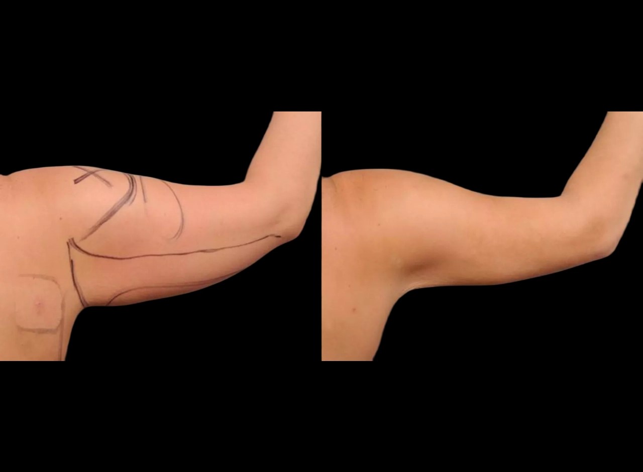 Arm liposuction in abu dhabi