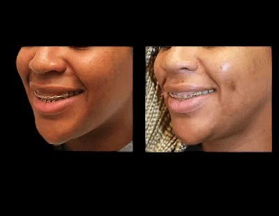 Facial reconstruction before after