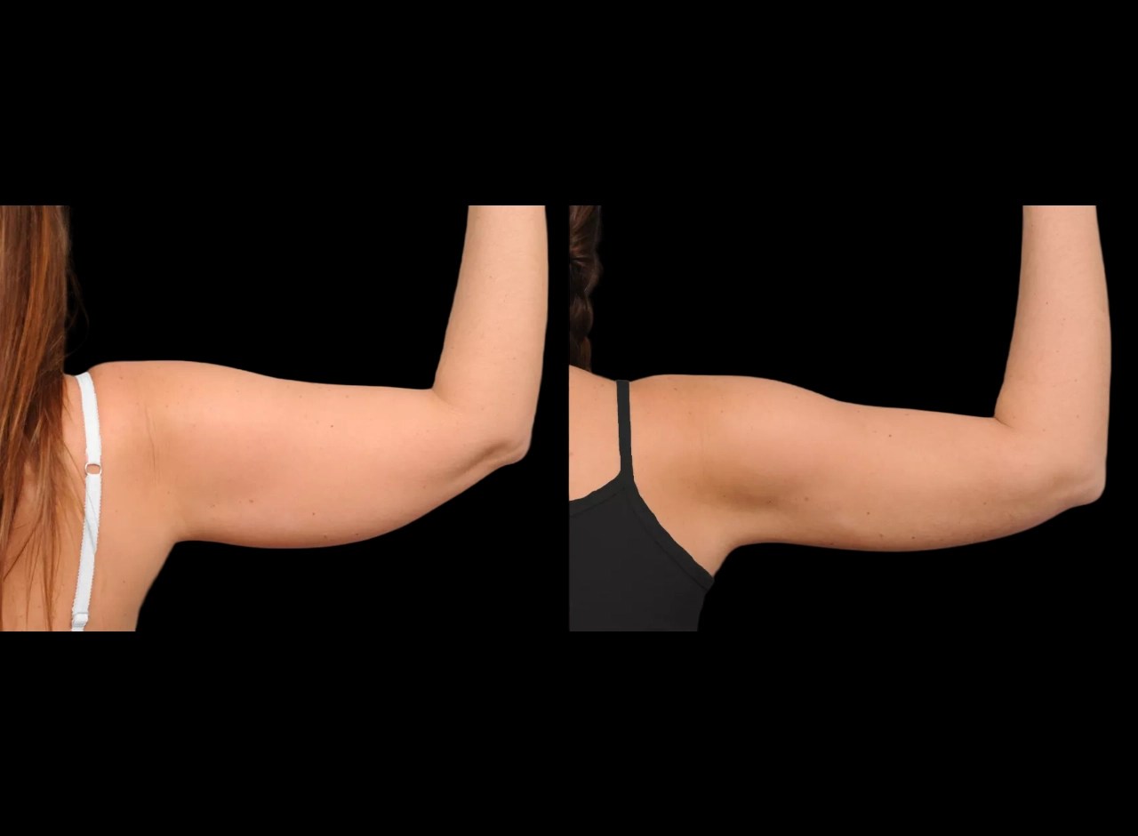 Arm fat transfer images in dubai