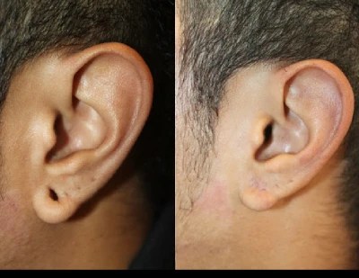 Ear piercing cost in dubai