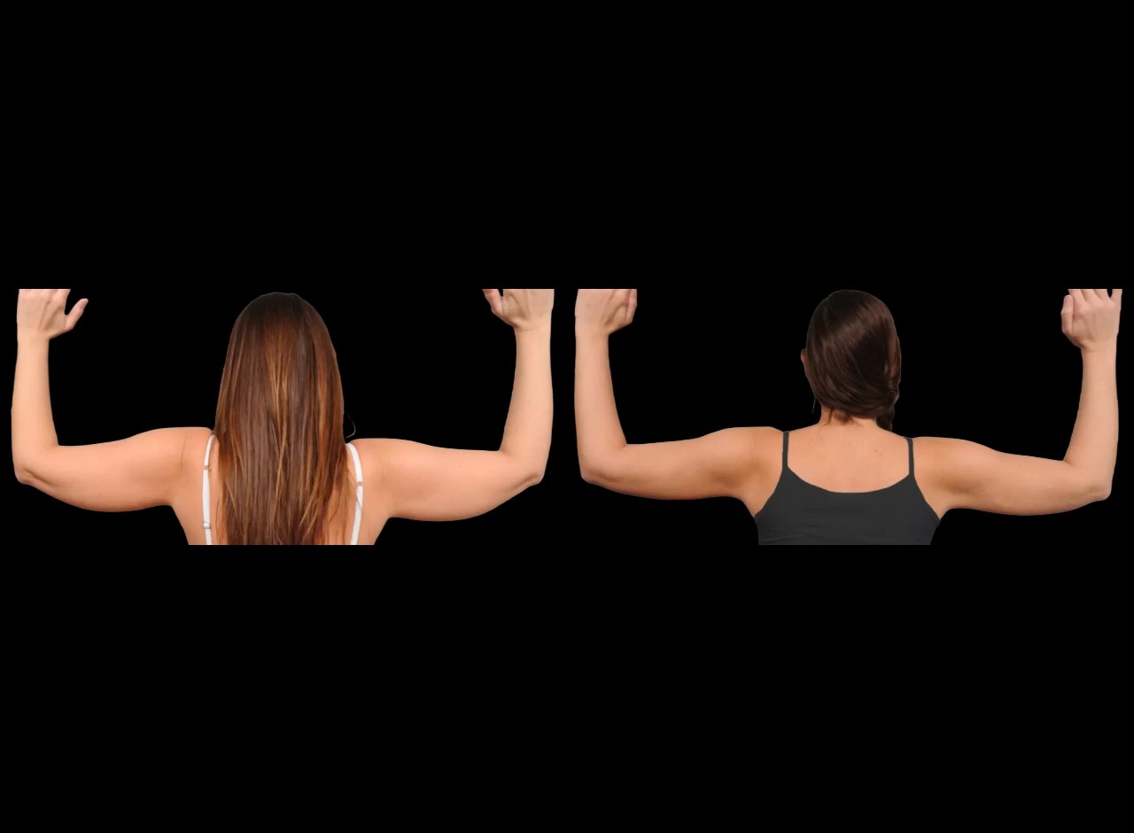 Arm fat transfer recovery in dubai