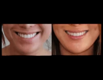 Facial reconstruction before after