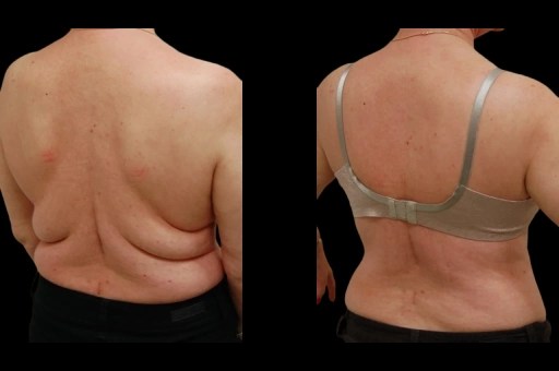 Upper back lift before and after images in dubai