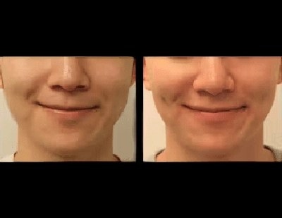 Dimple creation before and after results in abu dhabi for men