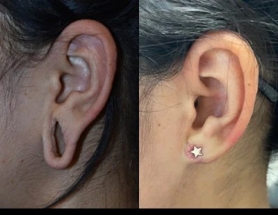 Ear piercing cost in dubai
