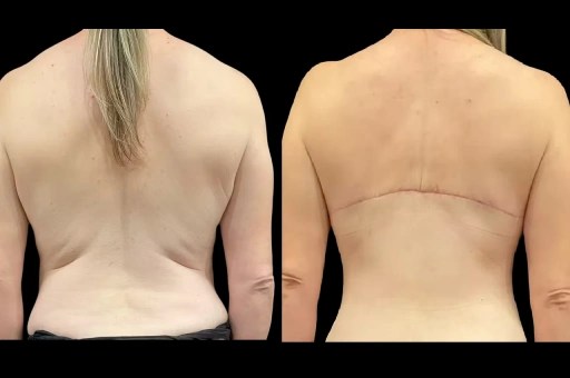 Upper back lift