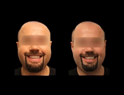 Dimple creation before and after images in dubai