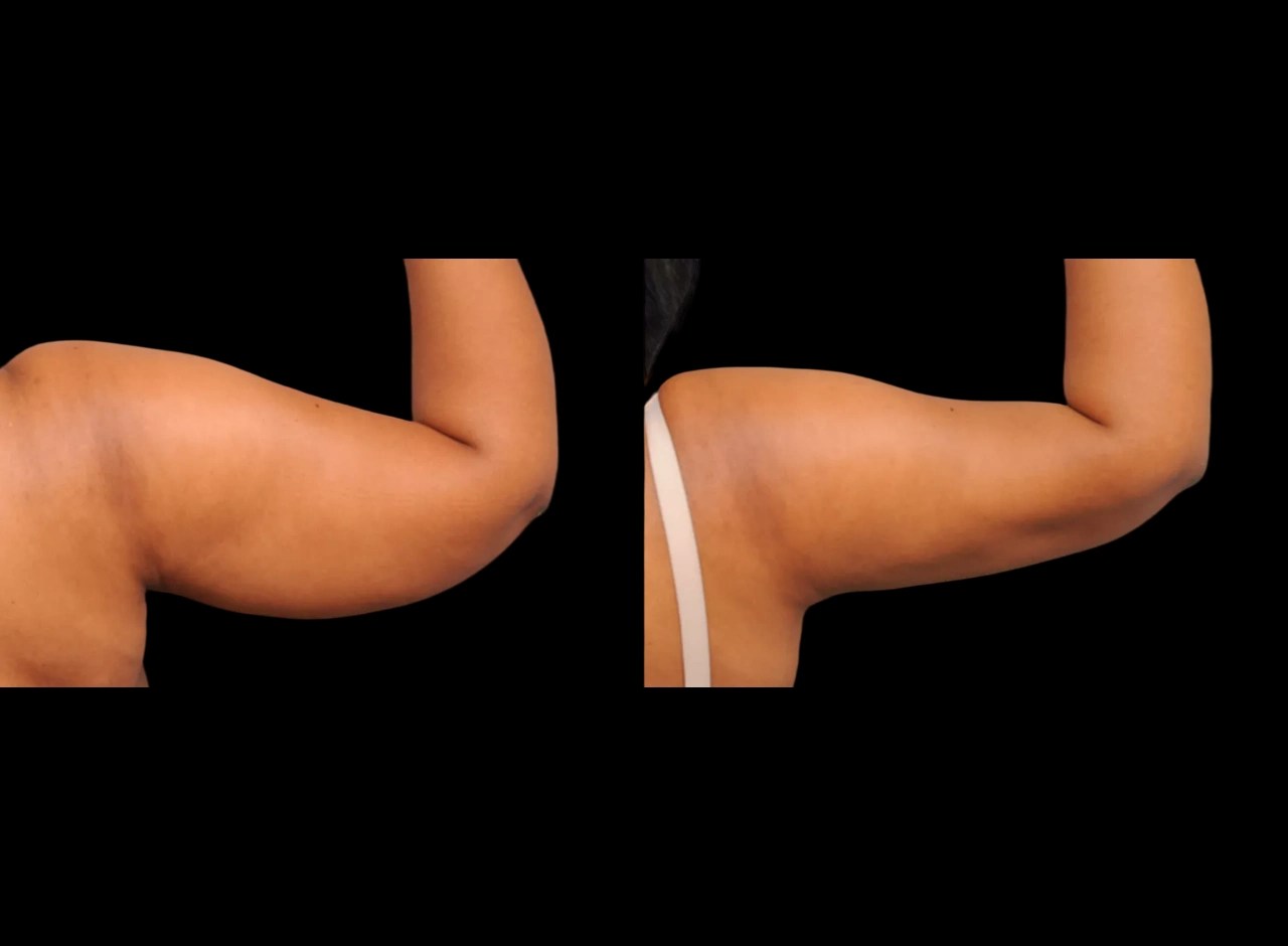 Arm fat transfer in uae