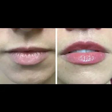 Lip lift