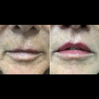 Lip lift