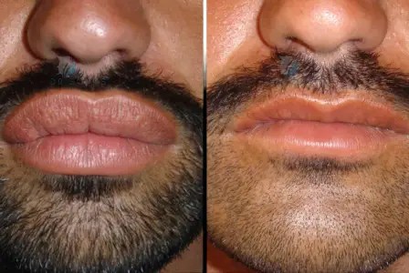 Lip reduction for male in dubai