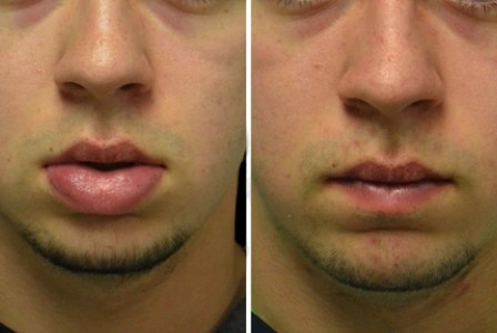 Facial reconstruction before after