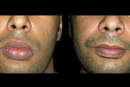 Lip reduction for male in abu dhabi