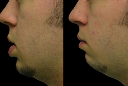 Lip reduction for male in uae