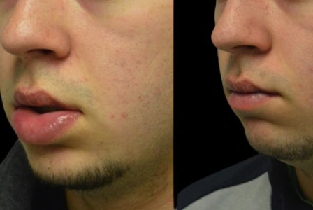Lip redution