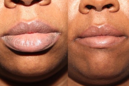 Lip reduction before and after in dubai