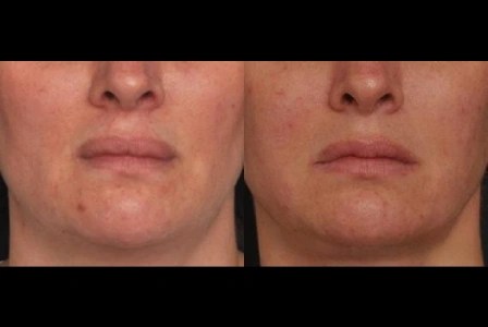 Lip reduction before and after in uae