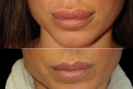 Lip reduction before and after in abu dhabi