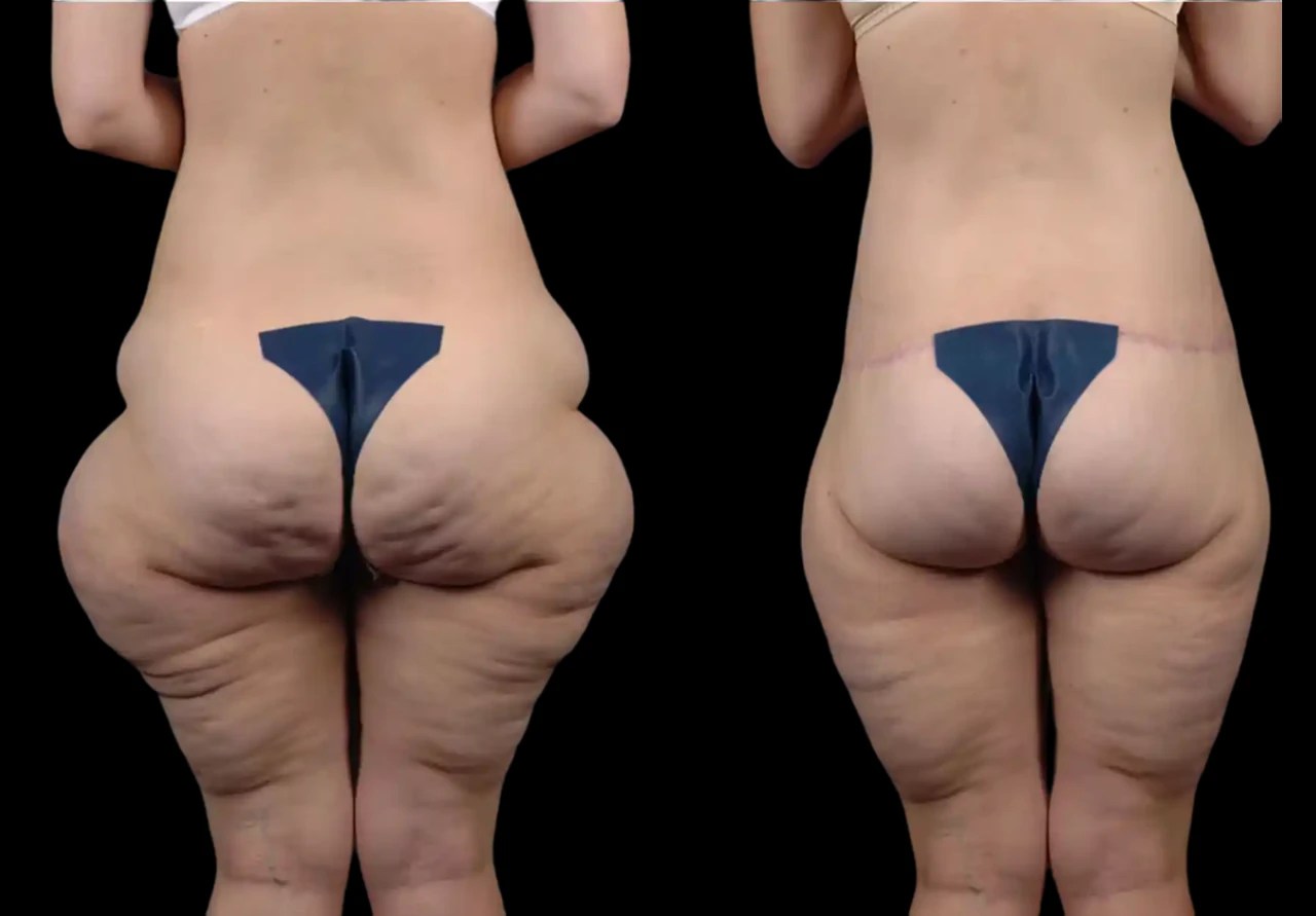 Thigh lift