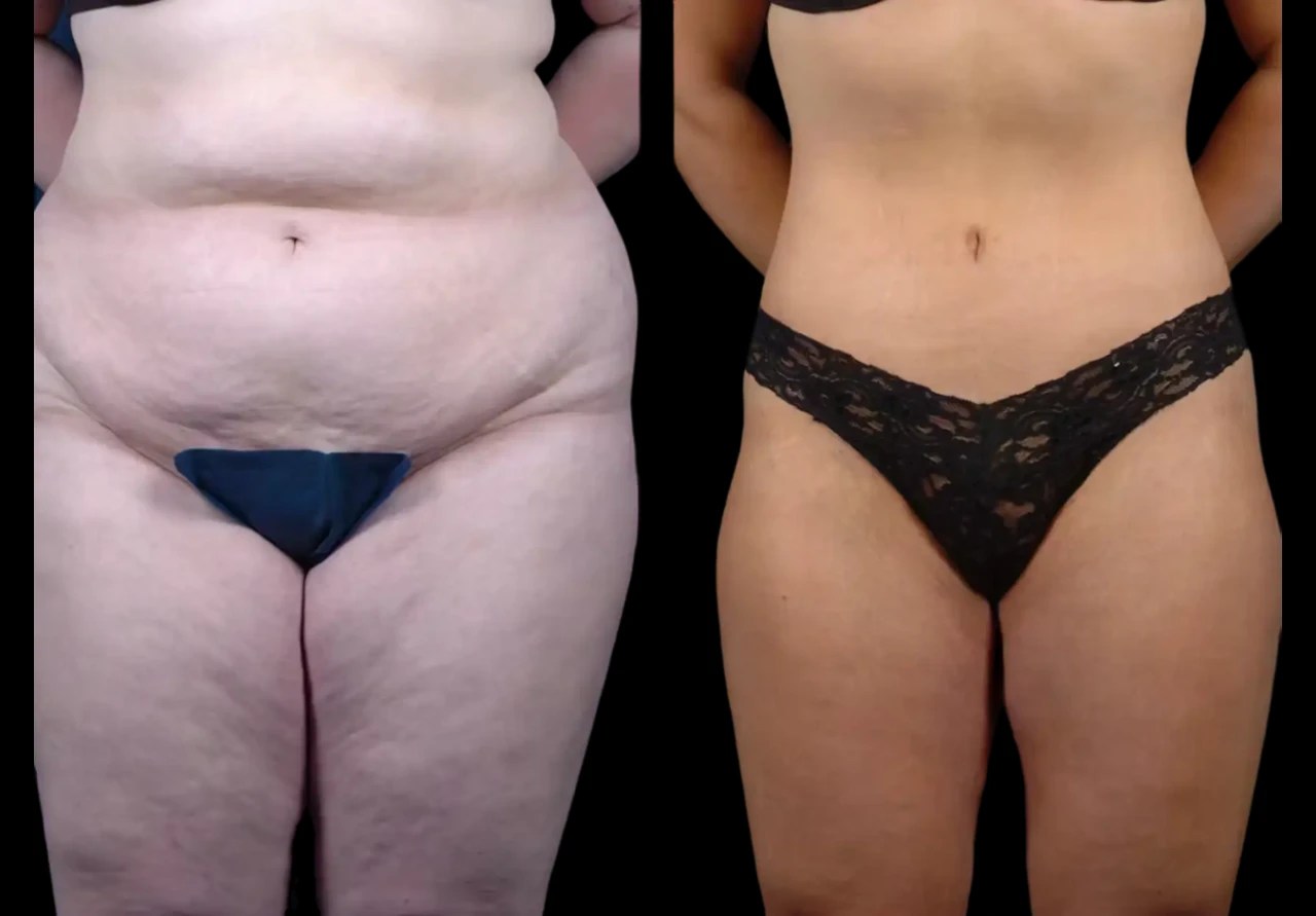Thigh lift