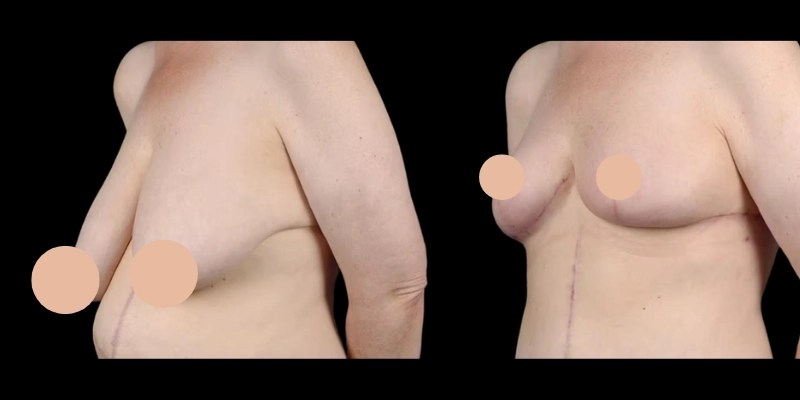 Breast Reduction before and after results in dubai