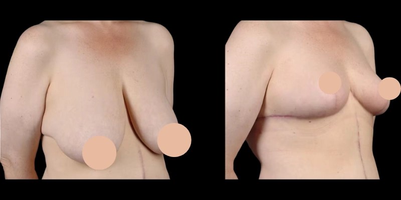 Breast Reduction before and after results in uae