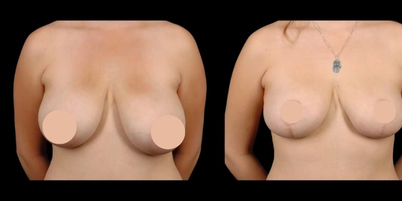 Breast Reduction before and after results in abu dhabi