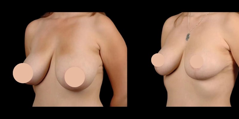 Breast liposuction