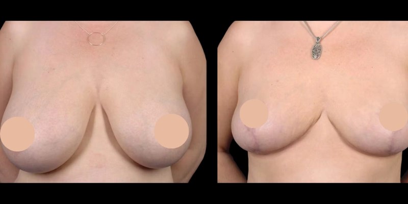 Breast liposuction