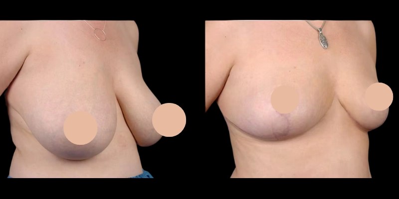 Breast liposuction