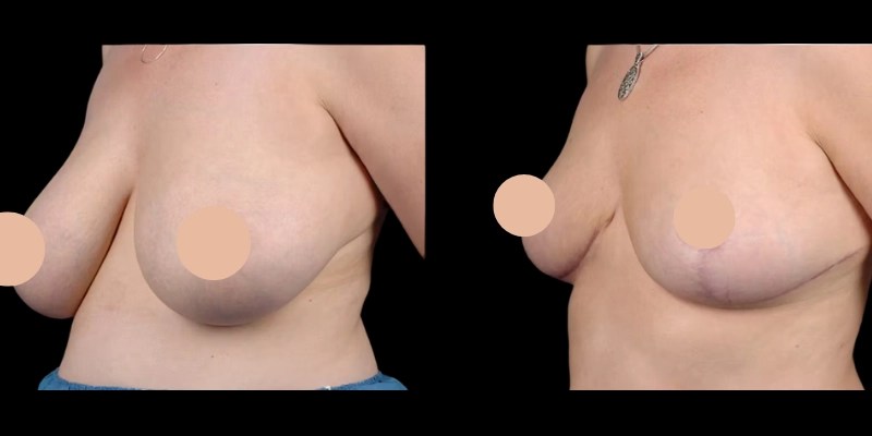Breast liposuction
