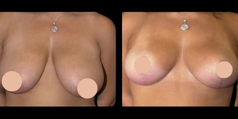 Breast liposuction