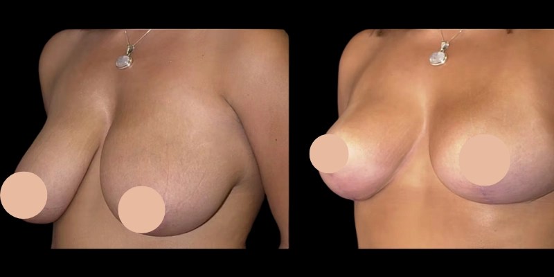 Breast liposuction