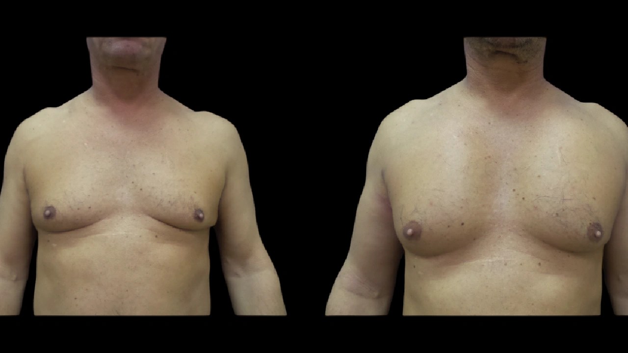 Male chest implant before and after in abu dhabi