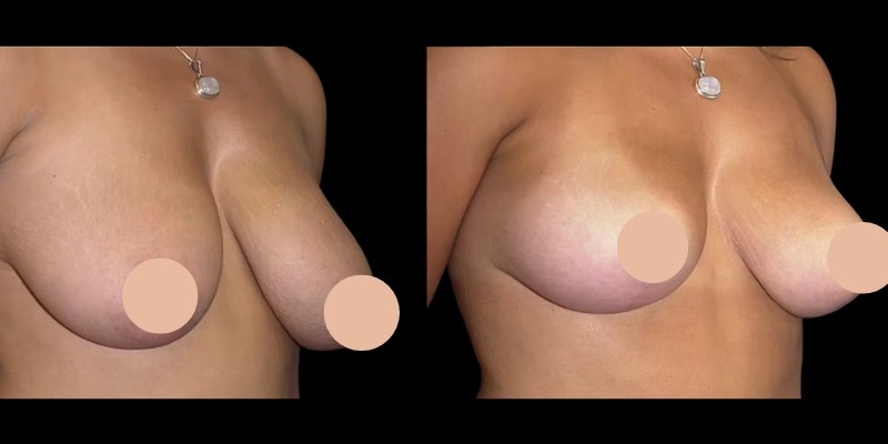 Breast liposuction