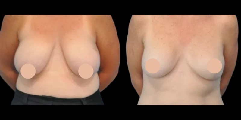 fat transfer breast reconstruction results in dubai