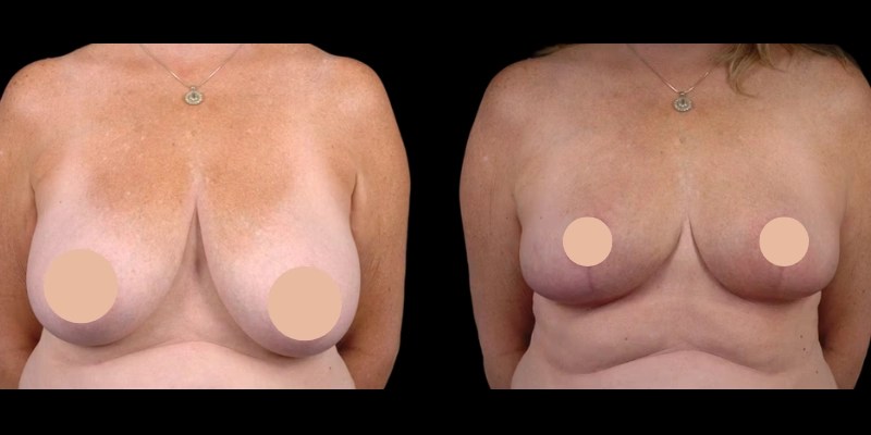 Breast Reduction before and after images in dubai