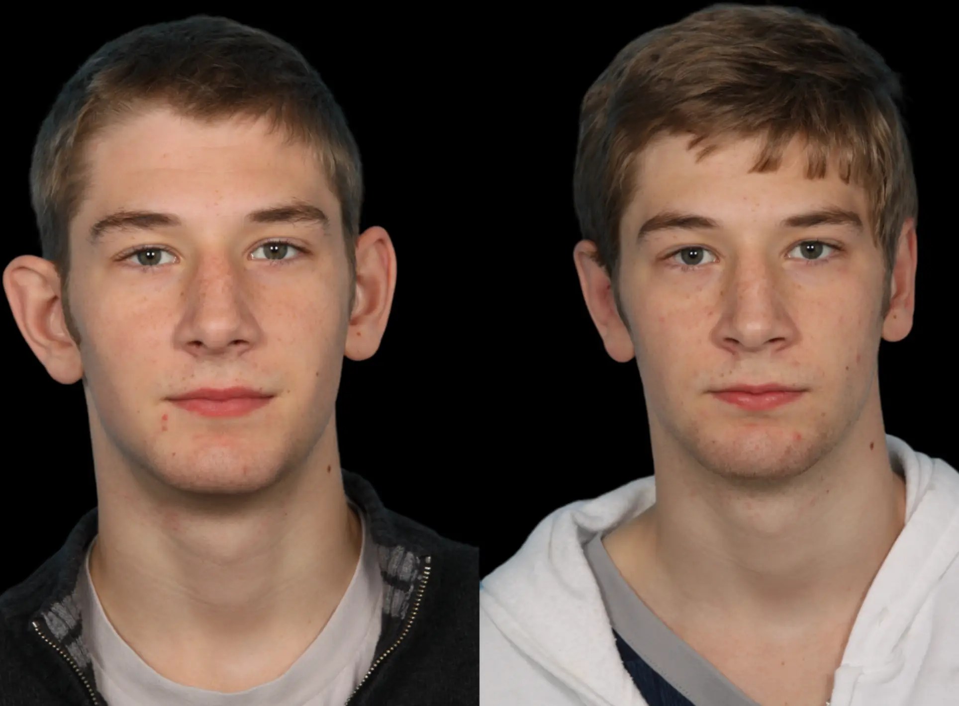 Facial reconstructive surgery
