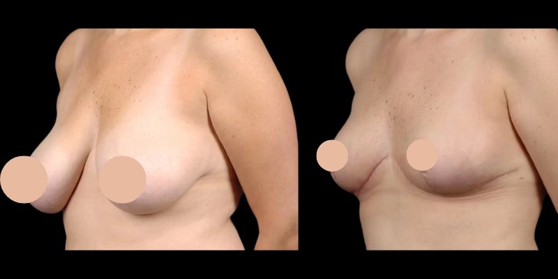 Breast Reduction before and afte in UAE